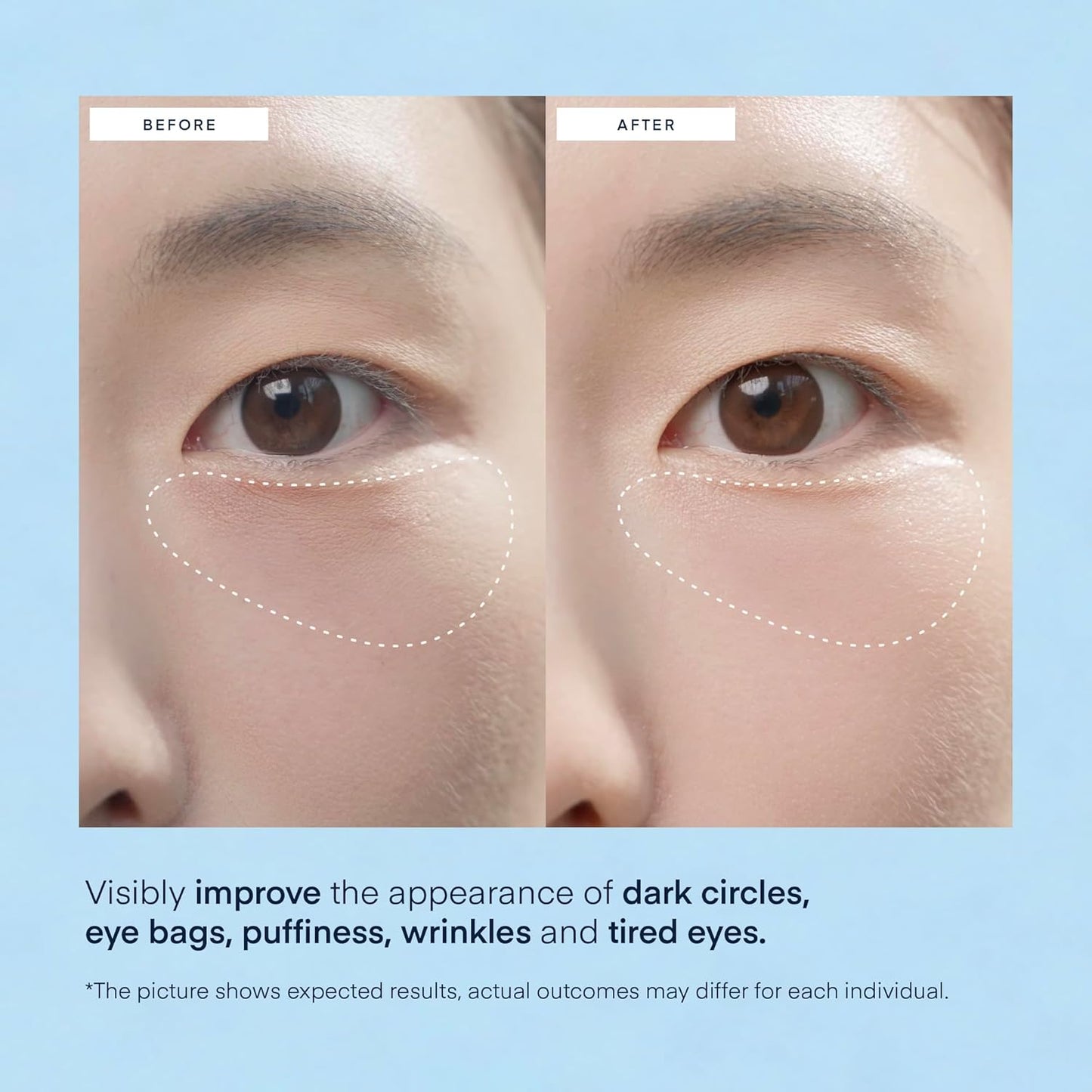 Parches Para Bolsas Y Ojeras, Mascarilla En Gel Coreano Terez & Honor
